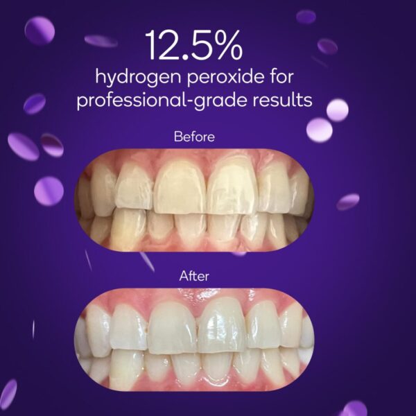 BURST Professional Whitening Kit - Image 2