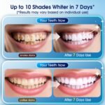 Professional Teeth Whitening Kit - Image 2