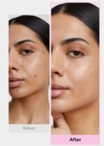 Easyderm Tea Tree Patch Set - Image 4