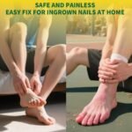 Titanium Ingrown Toenail Kit - Image 3