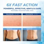 Folliculitis Treatment Cream - Image 2